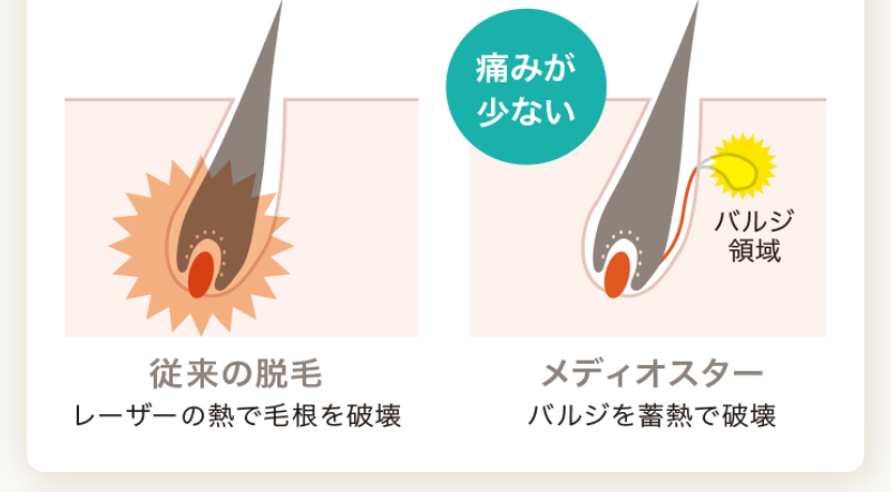 こだわり脱毛機メディオスター-8