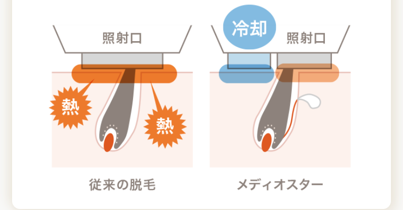 こだわり脱毛機メディオスター-10