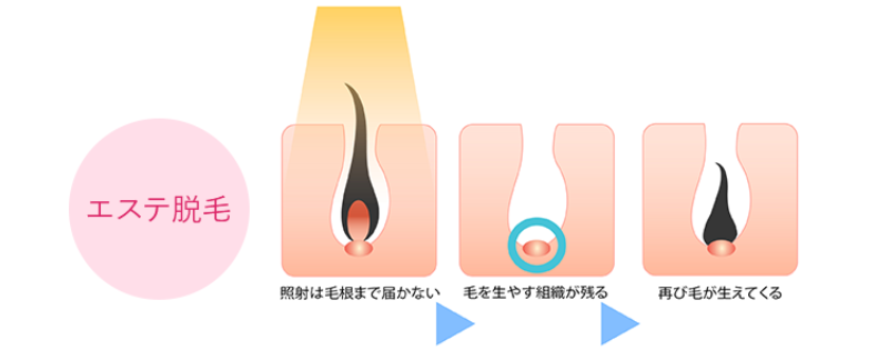 エステ脱毛と医療脱毛の違い-2