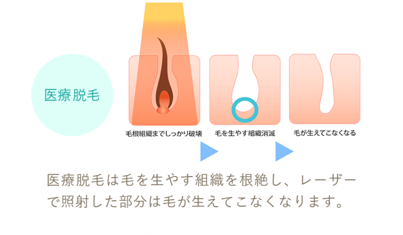エステ脱毛と医療脱毛の違い-4